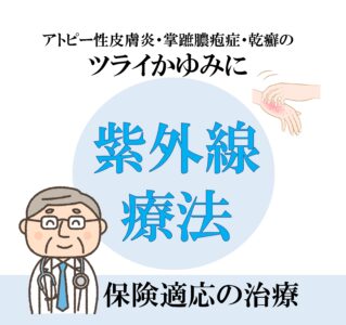 紫外線療法のアイキャッチ画像
